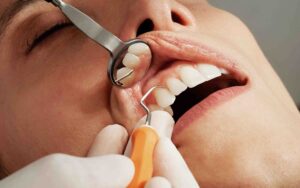 Dental Implants